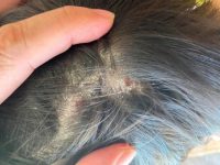 Các loại bệnh về da đầu thường gặp