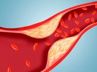 Cholesterol LDL gây ra tình trạng tích tụ chất béo, làm tắc mạch máu